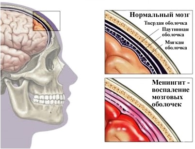 менингит менингит